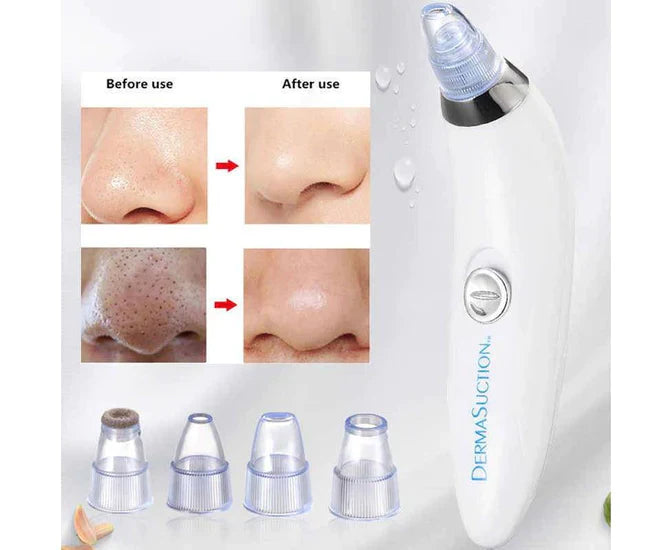 Derma Suction Blackheads Remover Device Blackhead Extractor